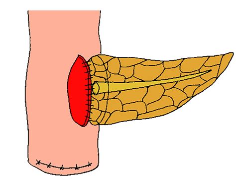 One Purse String Suture And Two U Shaped Mattress Sutures The