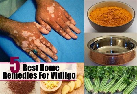 5 Best Home Remedies For Vitiligo Vitiligo Treatment Vitiligo