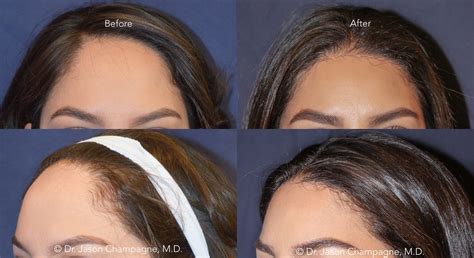 Hairline Lowering Vs Hair Transplantation — Plastic Surgeon Beverly