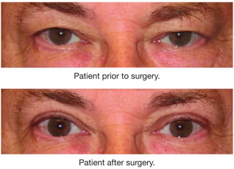 eyelid surgery eye doctors