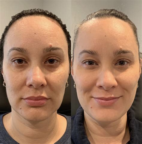 Dermal Fillers Before And After Pictures Case 65 Sacramento Ca
