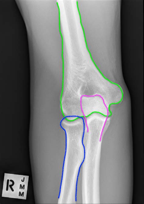 Emrad Radiologic Approach To The Traumatic Elbow Med Tac