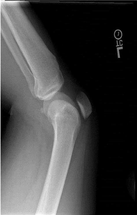 Lateral Radiograph Showing The Osteosarcoma Of Distal Left Femur As A