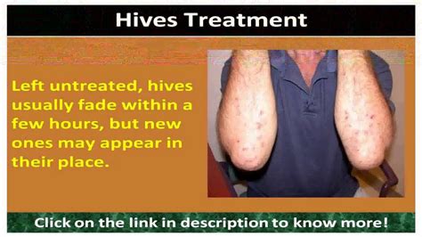 Urticaria Hives Treatment Youtube