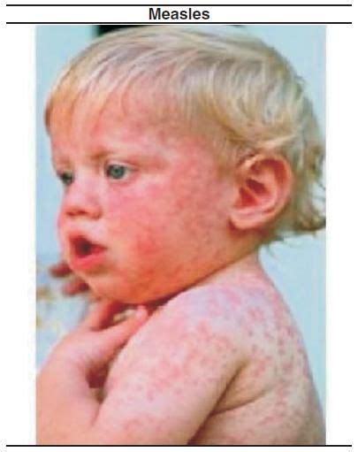 Childhood Rashes That Present To The Ed Part I Viral And Bacterial