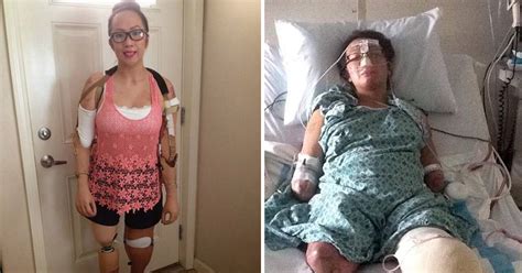 Meet The Human Mannequin Brave Woman Who Lost Limbs To Meningitis Is Now Per Cent Plastic