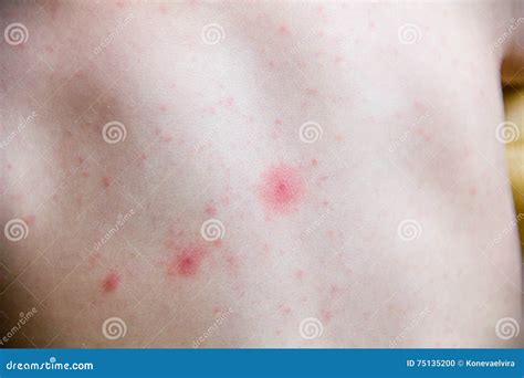 Bambino Con Il Problema Della Dermatite Dell Eruzione Sofferenza Impetuosa Di Allergia Dalle