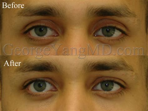 Upper Eyelid Filler 2693 George Yang Md New York Facial Plastic