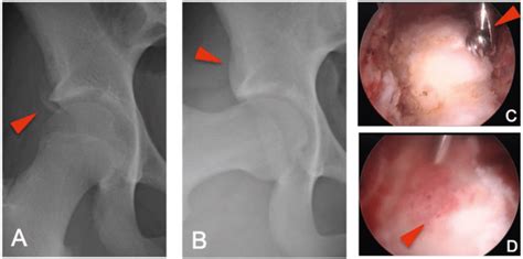 Hip Arthroscopy In The Pediatric And Adolescent Athlete Sems Journal