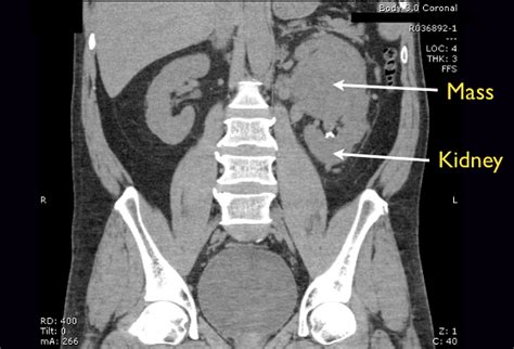 Ultrasound Detection Of A Renal Mass In A Patient With Flank Pain And