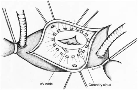 Surgical Tricuspid Valve Replacement Thoracic Key