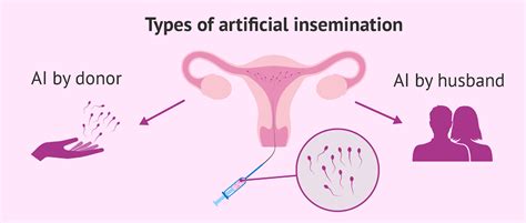 artificial insemination cost best low cost ivf 2021