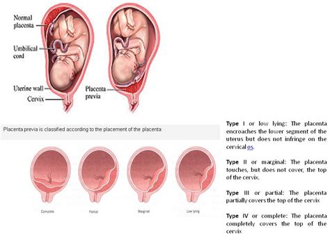 What are the types of placenta previa? QISTINA ZULAIKHA: August 2010