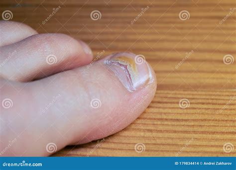 Damaged The Nail On My Big Toe From The Virus Stock Photo Image Of