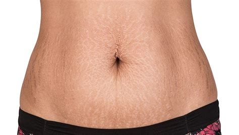 What S The Most Effective Way To Reduce Stretch Marks