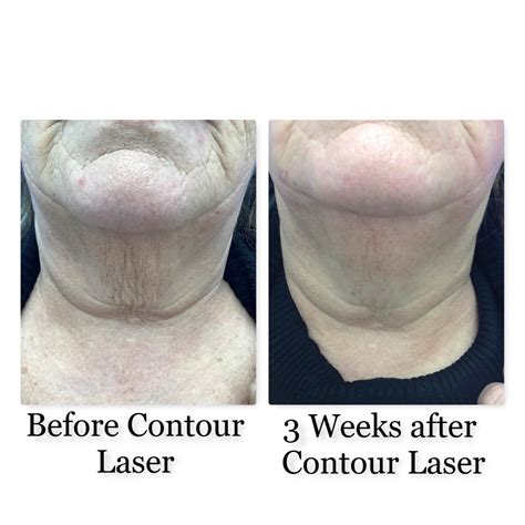 Contour Laser Facial Resurfacing Bismarck Nd Pure Skin Aesthetic