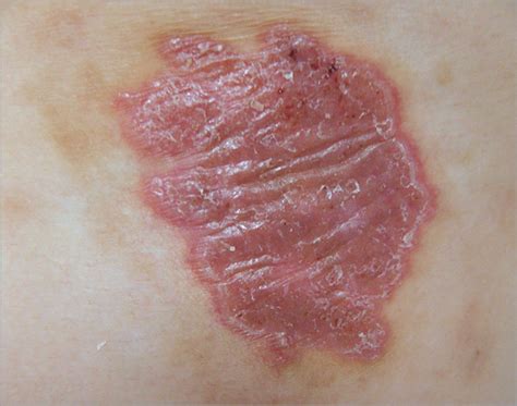 A Persistent Red Crusted Plaque On The Back Dermatology Jama Jama