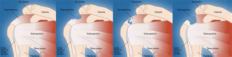 When Not To Have Rotator Cuff Surgery Know Your Options Centeno