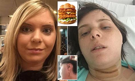 Woman Had Jaw Replaced After It Dislocated As She Stretched Her Mouth