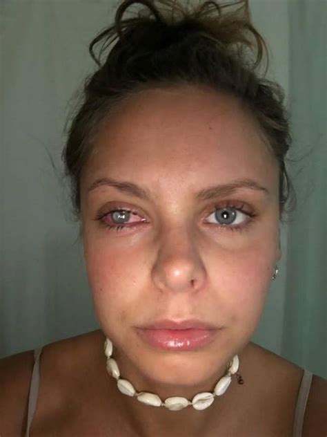 Woman Left Half Blinded After Getting Infection In Her Eye From Dirty