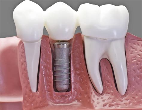 Cirug A De Implante Dental Valencia Cl Nica Dental Almar