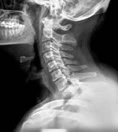 We did not find results for: Radiculopatia Cervical en un paciente con ocho vértebras ...