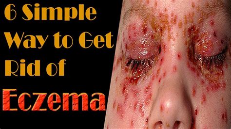 6 Simple Way To Get Rid Of Eczema How To Get Rid Of Eczema Youtube