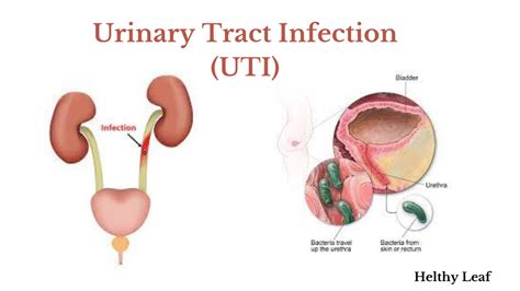Urinary Tract Infection Uti Facts And Treatment Helthy Leaf