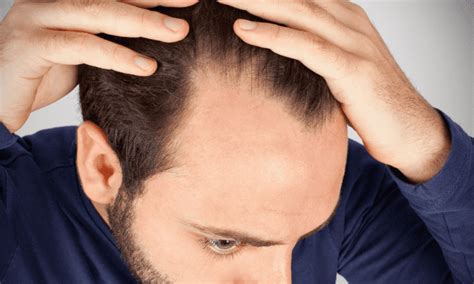 Understanding Hair Loss Causes Prevention And Treatment Sleep And