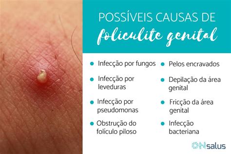 Foliculite Genital Causas Sintomas E Tratamento