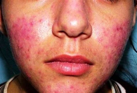 La scarsità di piastrine (piastrinopenia o trombocitopenia) può essere causata da diverse condizioni e patologie, le cui cause tipicamente ricadono in una di queste categorie Why are some pimples so much more painful than others? - Quora