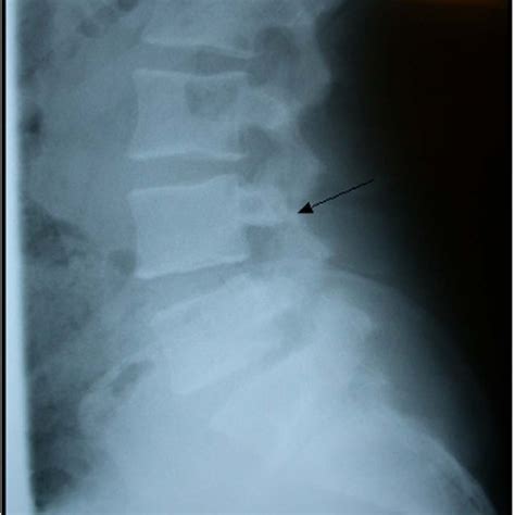 Lateral Plain X Ray Film Showing A Spondyloslisthesis At L 4 Arrow