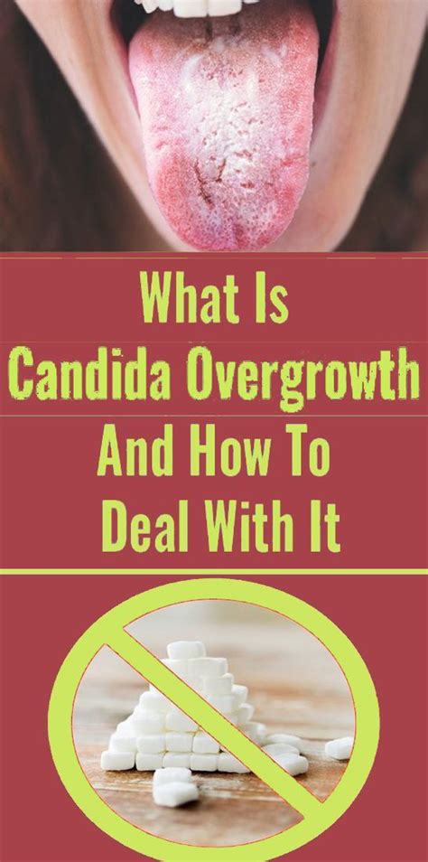 Health Infographic What Is Candida Overgrowth And How To Deal With It
