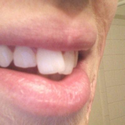 Can my broken front tooth be fixed? Can a veneer be placed to fix a crooked tooth? (photo ...