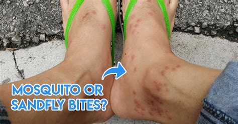7 Insect Bites Singaporeans Have Gotten At Some Point And How To Identify