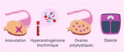 Symptômes du syndrome des ovaires polykystiques