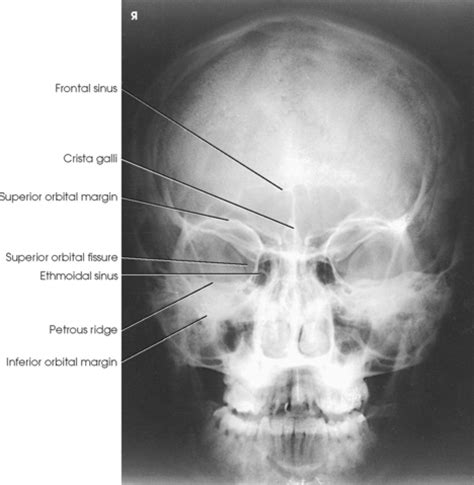 Additionally, it is also used to determine if the sinuses are clear or infected. FACIAL BONES | Radiology Key