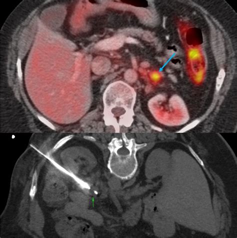 Adrenal Ct Guided Biopsy