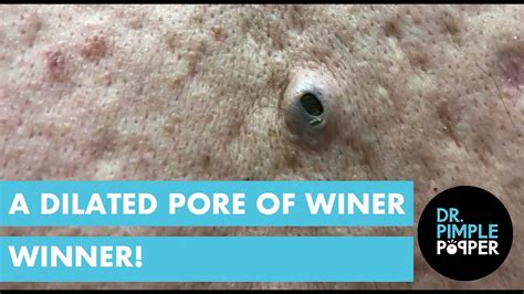 A Dilated Pore Of Winer Winner Youtube