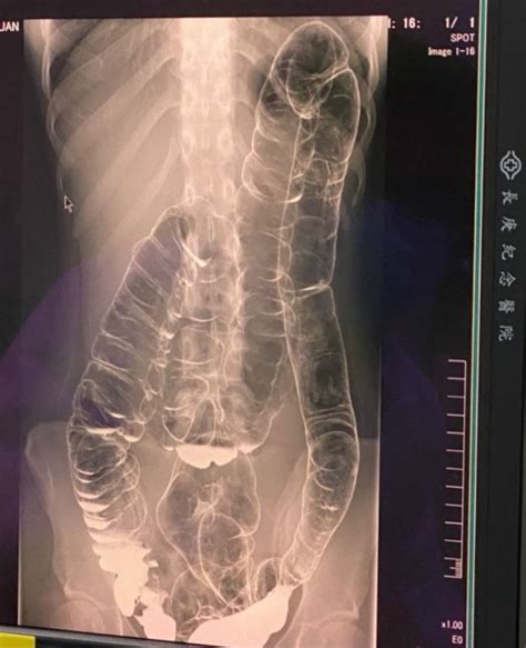 Taiwan Woman With Bad Constipation Posts X Ray Scan Netizens Shocked