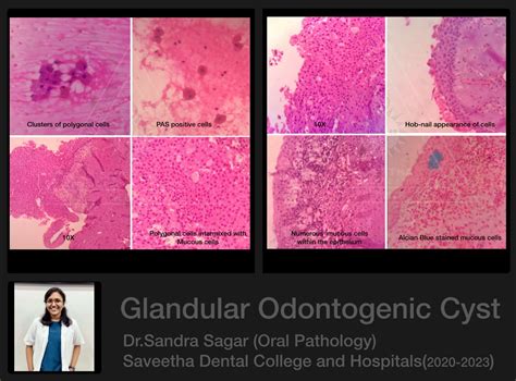 Glandular Odontogenic Cyst — Oral Pathology Saveetha
