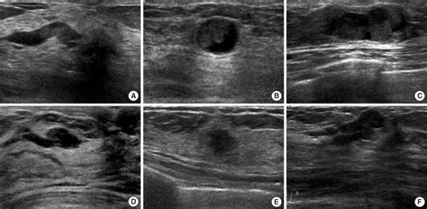 Is Us Guided 14 Gauge Core Needle Biopsy Valid For Papillary Neoplasm