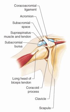 Rotator cuff tendonitis refers to the acute (recent) irritation of the tendon of the rotator cuff and often the surrounding bursa. Wong Progress: Injury Management: Shoulder Impingement (Subacromial)