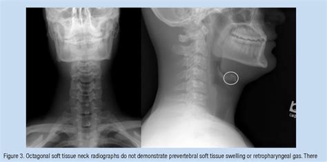Figure 3 from Isolated Hyoid Bone Fractures in Collegiate Football