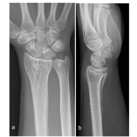 Distal Radius Fracture Treated With A 27 Mm Carbonpeek Plate X Ray 1