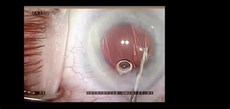 Dropless Cataract Surgery Touchophthalmology