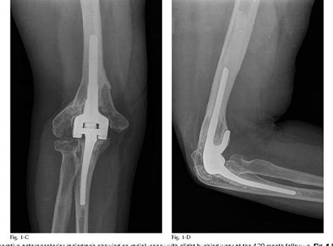 Figure 2 From Clinical Outcomes Of Semiconstrained Total Elbow