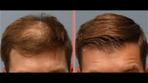 Hair Transplant Surgery In Turkey Try Now Youtube