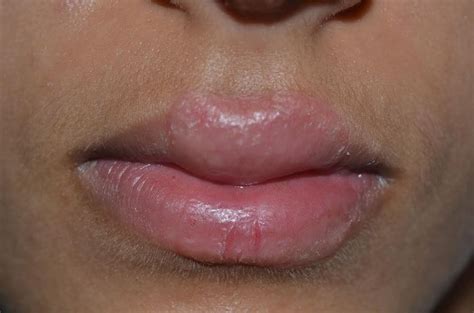 Eczema Lips Swollen