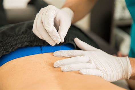 Muscle Pain Therapy Dry Needling Franklin Rehabilitation